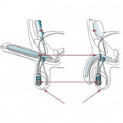 Phương pháp cấy chỉ dương vật